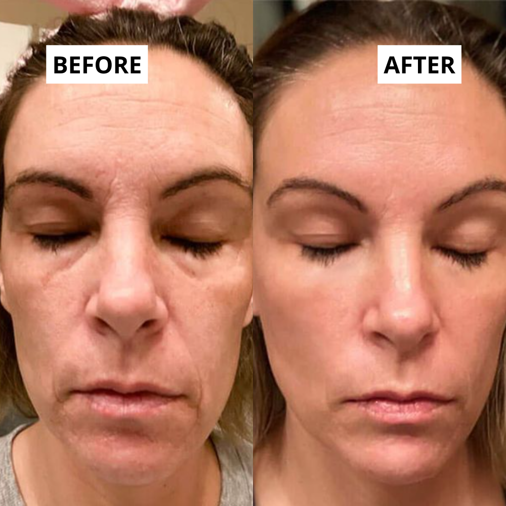 LED Gezichtsmasker - Lichttherapie met Infrarood & Rood licht