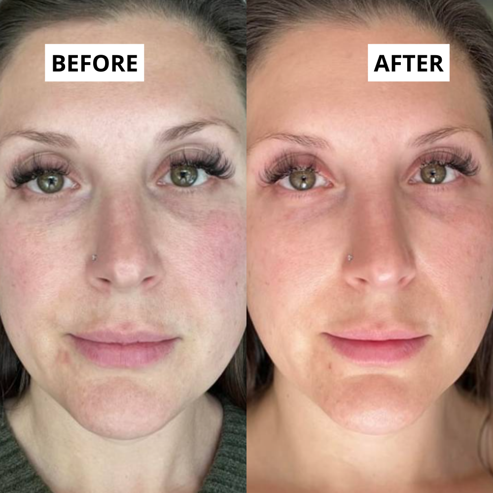 LED Gezichtsmasker - Lichttherapie met Infrarood & Rood licht